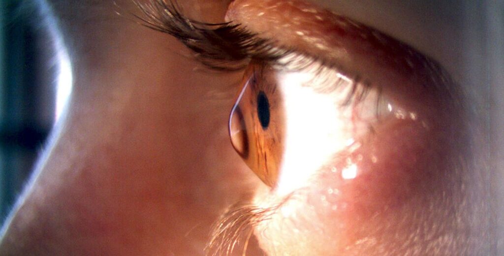 Діагностика та лікування кератоконусу – Крос-лінкінг | Lviv Medical Center | Львів Медікал Центр | ЛМЦ Діагностика та лікування кератоконусу – Крос-лінкінг | Lviv Medical Center | Львів Медікал Центр | ЛМЦ