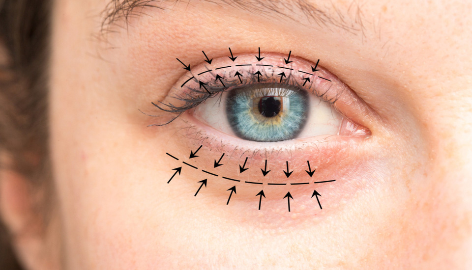 Що таке блефаропластика? | Lviv Medical Center | Львів Медікал Центр | ЛМЦ