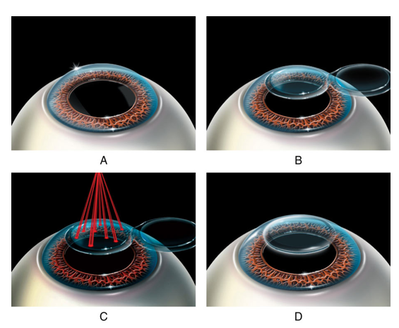 Лазерна корекція зору — ключовий напрямок діяльності клініки  Lviv Medical Center. | Lviv Medical Center | Львів Медікал Центр | ЛМЦ