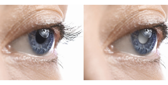 Лікування глаукоми | Lviv Medical Center | Львів Медікал Центр | ЛМЦ