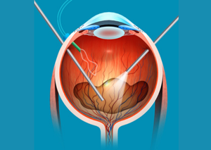 Вітреоретинальна хірургія | Lviv Medical Center | Львів Медікал Центр | ЛМЦ Вітреоретинальна хірургія | Lviv Medical Center | Львів Медікал Центр | ЛМЦ