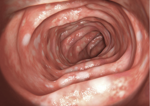 Колоноскопія | Lviv Medical Center | Львів Медікал Центр | ЛМЦ