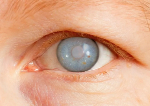 Лікування глаукоми | Lviv Medical Center | Львів Медікал Центр | ЛМЦ