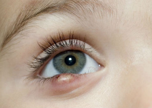 Видалення халязіону