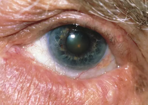 Заворіт та виворіт повік