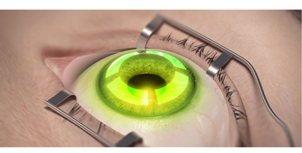 Лікування кератоконусу | Lviv Medical Center | Львів Медікал Центр | ЛМЦ