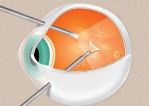 Вітреоретинальна хірургія | Lviv Medical Center | Львів Медікал Центр | ЛМЦ Вітреоретинальна хірургія | Lviv Medical Center | Львів Медікал Центр | ЛМЦ