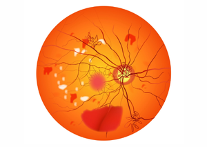 Вітреоретинальна хірургія | Lviv Medical Center | Львів Медікал Центр | ЛМЦ Вітреоретинальна хірургія | Lviv Medical Center | Львів Медікал Центр | ЛМЦ