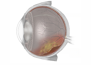 Вітреоретинальна хірургія | Lviv Medical Center | Львів Медікал Центр | ЛМЦ Вітреоретинальна хірургія | Lviv Medical Center | Львів Медікал Центр | ЛМЦ