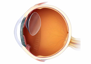 Вітреоретинальна хірургія | Lviv Medical Center | Львів Медікал Центр | ЛМЦ Вітреоретинальна хірургія | Lviv Medical Center | Львів Медікал Центр | ЛМЦ