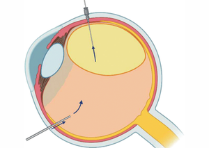 Вітреоретинальна хірургія | Lviv Medical Center | Львів Медікал Центр | ЛМЦ Вітреоретинальна хірургія | Lviv Medical Center | Львів Медікал Центр | ЛМЦ