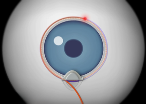 Лікування глаукоми | Lviv Medical Center | Львів Медікал Центр | ЛМЦ