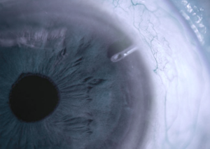 Лікування глаукоми | Lviv Medical Center | Львів Медікал Центр | ЛМЦ