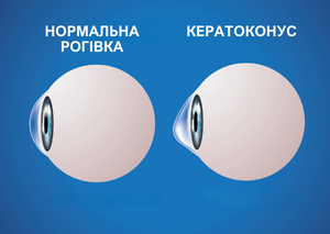 Лікування кератоконусу | Lviv Medical Center | Львів Медікал Центр | ЛМЦ