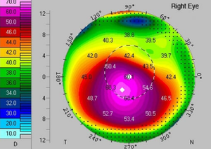 Лікування кератоконусу | Lviv Medical Center | Львів Медікал Центр | ЛМЦ