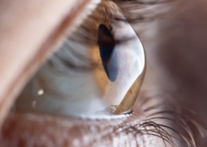 Лікування кератоконусу | Lviv Medical Center | Львів Медікал Центр | ЛМЦ