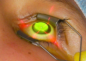 Лікування кератоконусу | Lviv Medical Center | Львів Медікал Центр | ЛМЦ