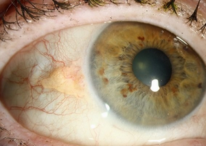 Інші операції переднього відрізку | Lviv Medical Center | Львів Медікал Центр | ЛМЦ