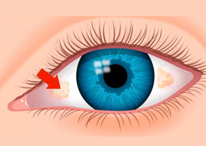 Інші операції переднього відрізку | Lviv Medical Center | Львів Медікал Центр | ЛМЦ