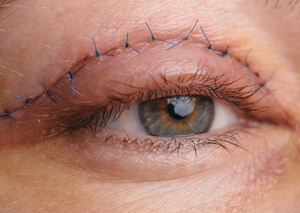 Пластика верхніх повік