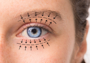 Кругова пластика повік