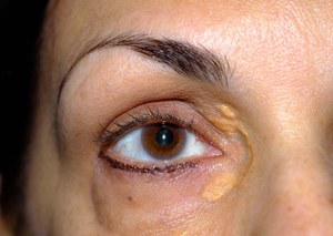 Видалення ксантелазм