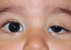 Корекція птозу верхніх повік